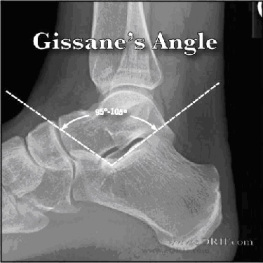 Figure 4: Gissane's Angle. https://dailyem.files.wordpress.com/2013/12/gissane.jpg