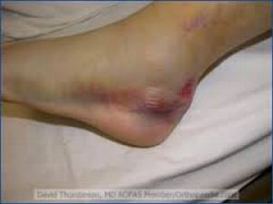 Figure 1: Left foot physical examination findings. https://www.aofas.org/PRC/conditions/Documents/Calcaneal-fracture.pdf
