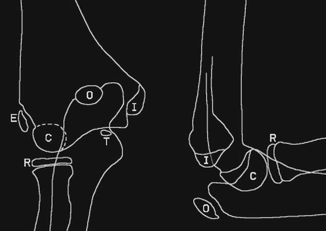 Figure 2: Elbow ossification centers, AP and lateral views. Images courtesy of orthobullets.com, Ujash Sheth and Chris Souder.