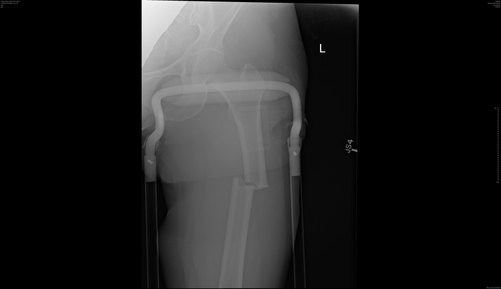 Figure 1: Initial femur imaging 
