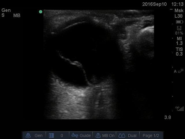 Figure 1: Ultrasound imaging of the right globe