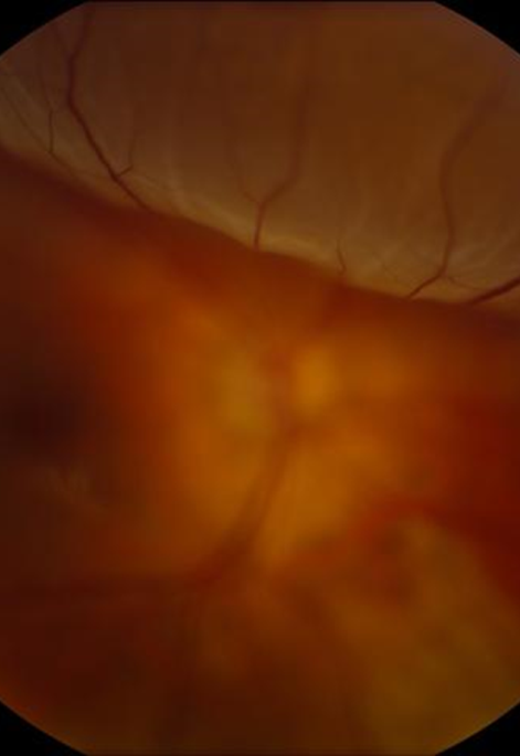 Figure 2: Retinal detachment as seen on ophthalmoscopic exam. Borrowed from http://emedicine.medscape.com/article/798501-overview