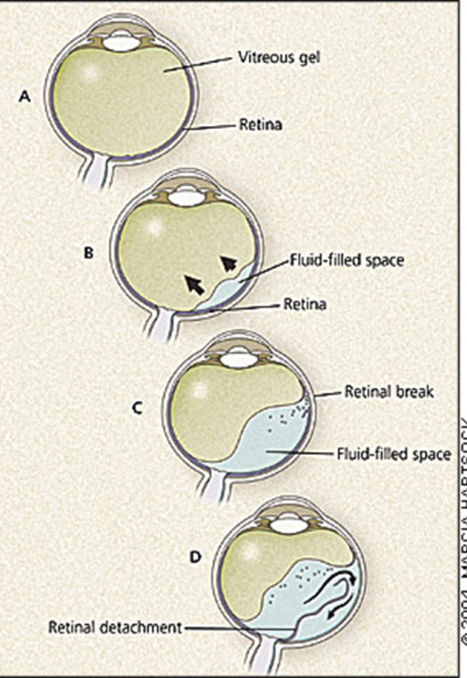 Figure 4: Anatomic depiction of retinal detachment. Borrowed from http://www.aafp.org/afp/2004/0401/p1691.html