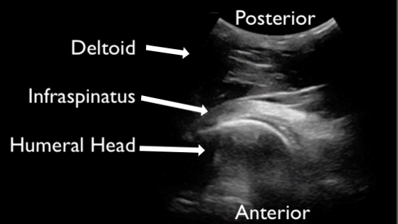 Figure 3: Normal Shoulder Anatomy on POCUS. Photo Source: https://sonostuff.com/2016/08/23/msk-pocus-2nd-installment-muscles-tendons-and-bones-oh-my-foamed-foamus-meded-ultrasound/