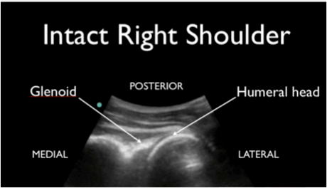 Figure 4: Normal Shoulder Anatomy on POCUS Photo Source: http://www.foamem.com/2014/06/05/shoulder-ultrasound-intra-articular-injection-and-reduction-2/