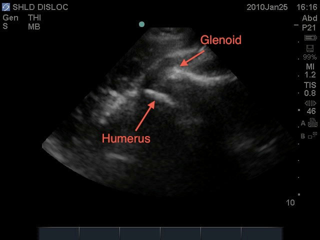 Figure 5: Anterior Shoulder Dislocation 
