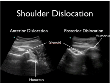 Figure 7: Comparing Anterior Dislocations to Posterior Dislocations. Photo Source: http://www.emdocs.net/wp-content/uploads/2014/06/shoulderDislocation.png