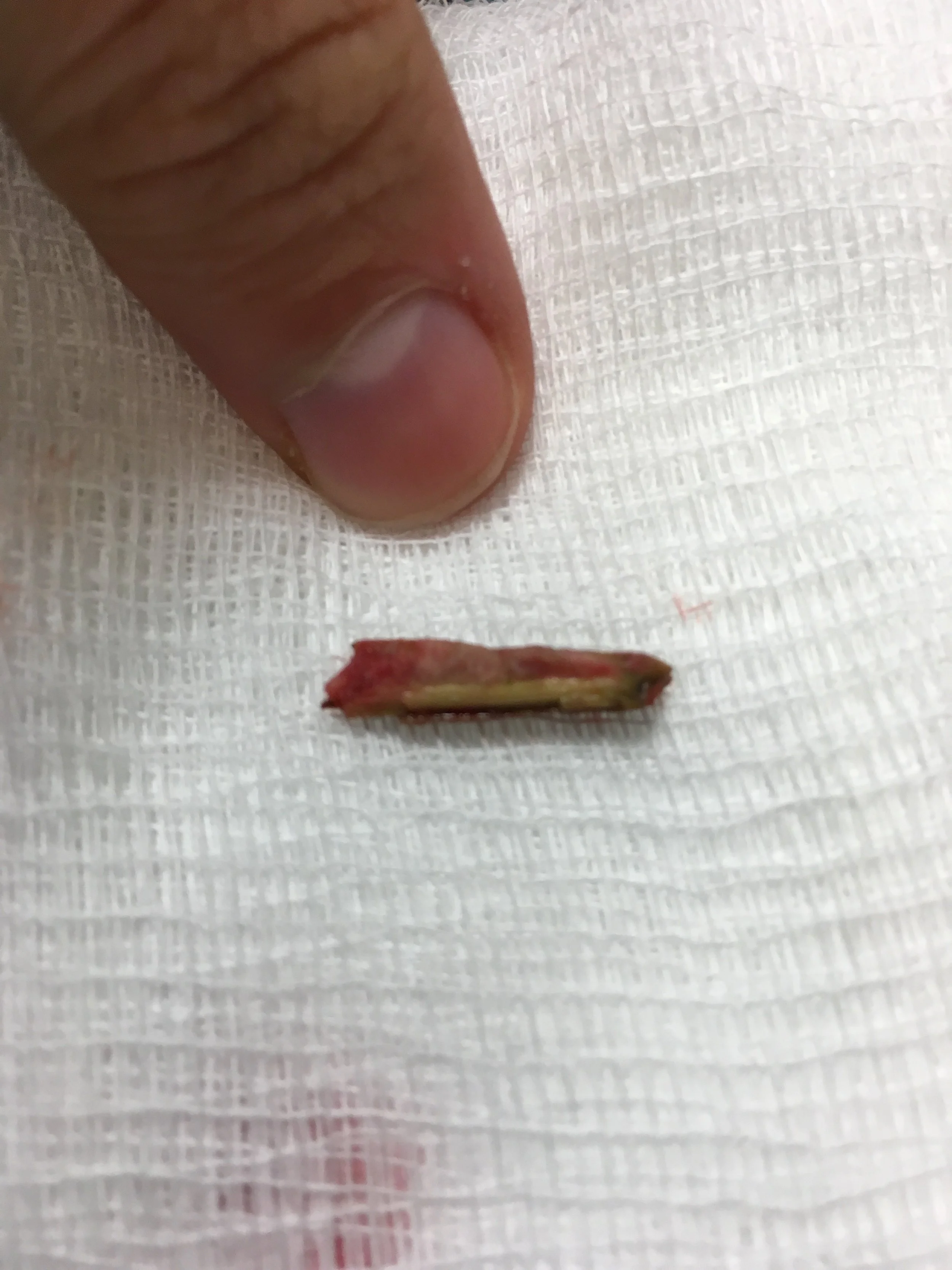 Figure 3: Retained foreign body removed!