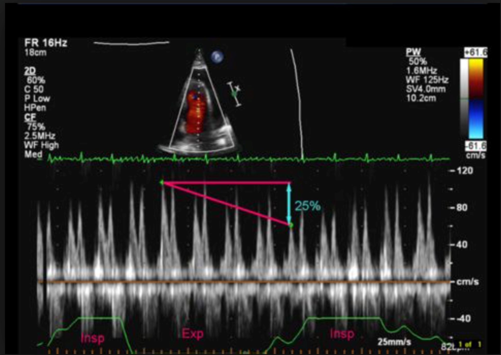 Image 1: Evaluating for pulsus paradoxus on bedside cardiac echo. 