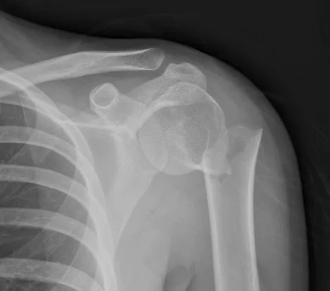 Image 2: AP radiograph of the left shoulder