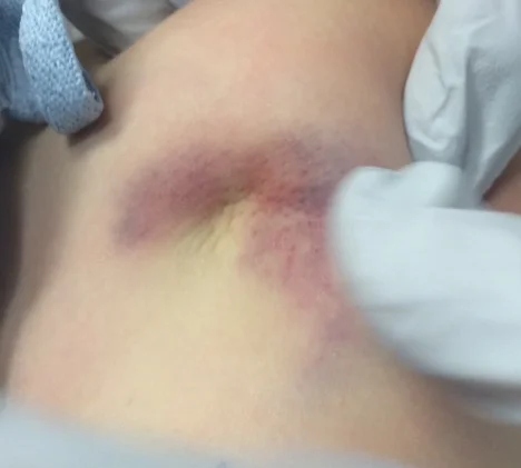 Image 3: Exam findings following closed reduction
