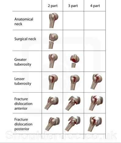 Image 4: Neer's Classification of humerus fractures. Figure created by https://www.shoulderdoc.co.uk/article/1457