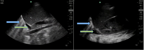 Figure 1: Right and left upper quadrant views of abdomen, respectively, demonstrating bilateral pleural effusions (green arrows) and B-lines (blue arrows).