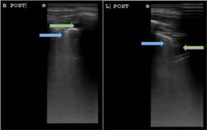 Figure 2: Right and left posterior lung fields, respectively, with diffuse B-lines bilaterally (blue arrows), as well as pleural effusions (green arrows).