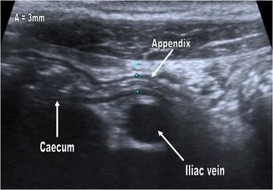 Figure 4: Photo source: https://www.researchgate.net/profile/Samuel_Stafrace2/publication/256332872/figure/fig3/AS:202764446638091@1425354219309/A-normal-appendix-is-seen-draped-over-the-iliac-vessels-in-a-10-year-old-girl-This-is.png