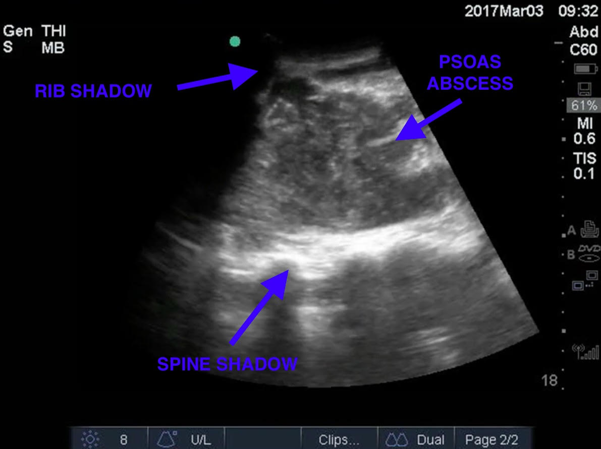 Image 2: RUQ US view demonstrating heterogenous mass within the psoas musculature