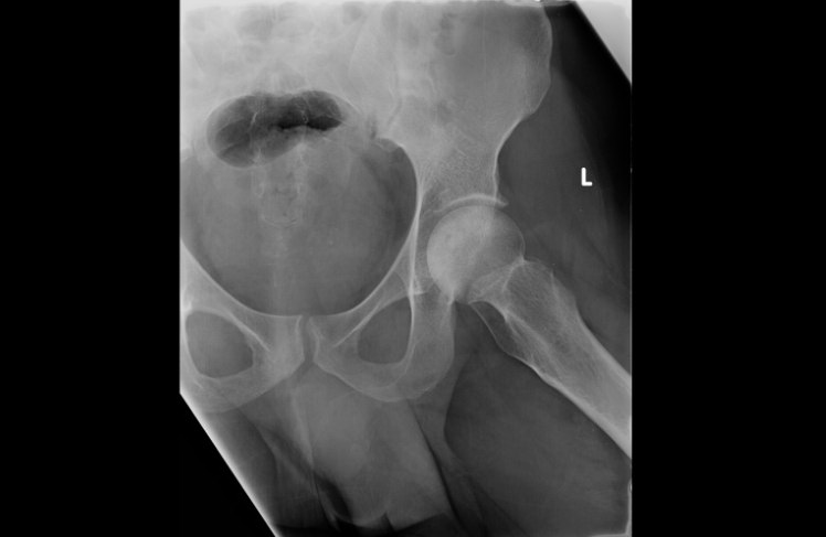 Figure 2: Lateral view of left hip 