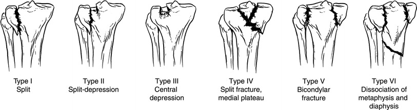 Figure 4: Schatzker Classification of Tibial Plateau Fractures. (Image from Zeltser et al, Classifications in Brief: Schatzker classification of tibial plateau fractures, Clinical Orthopedics and Related Research, 2013 Feb)