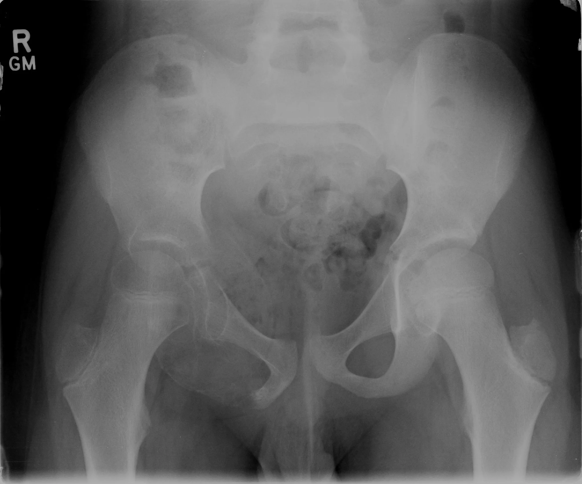 Figure 1: Anteroposterior pelvic radiograph