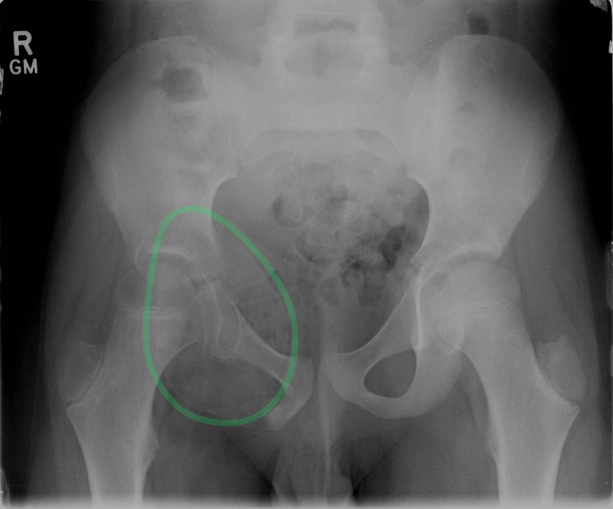 Figure 2: Re-demonstration of the anteroposterior pelvic radiograph in Figure 1, highlighting the radiolucent cystic lesion surrounded by a thin layer of bony cortex