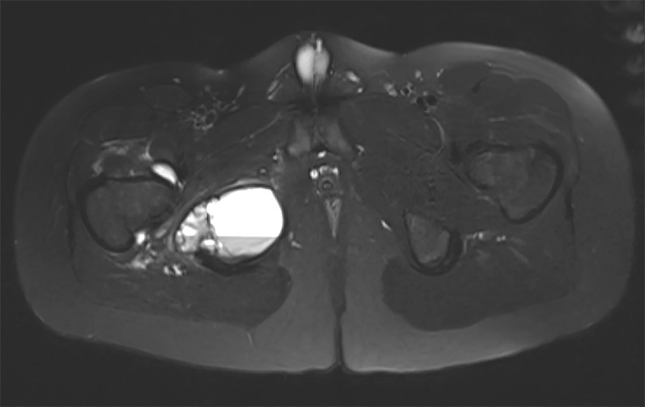 Figure 3: T2-weighted magnetic resonance, axial cross-sectional image of the pelvis demonstrating an expansile mass containing trabecular loculations and fluid-fluid levels