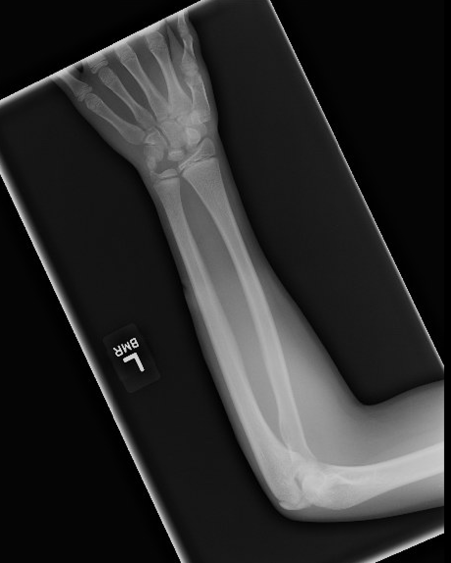 When a Simple Laceration is Not So Simple