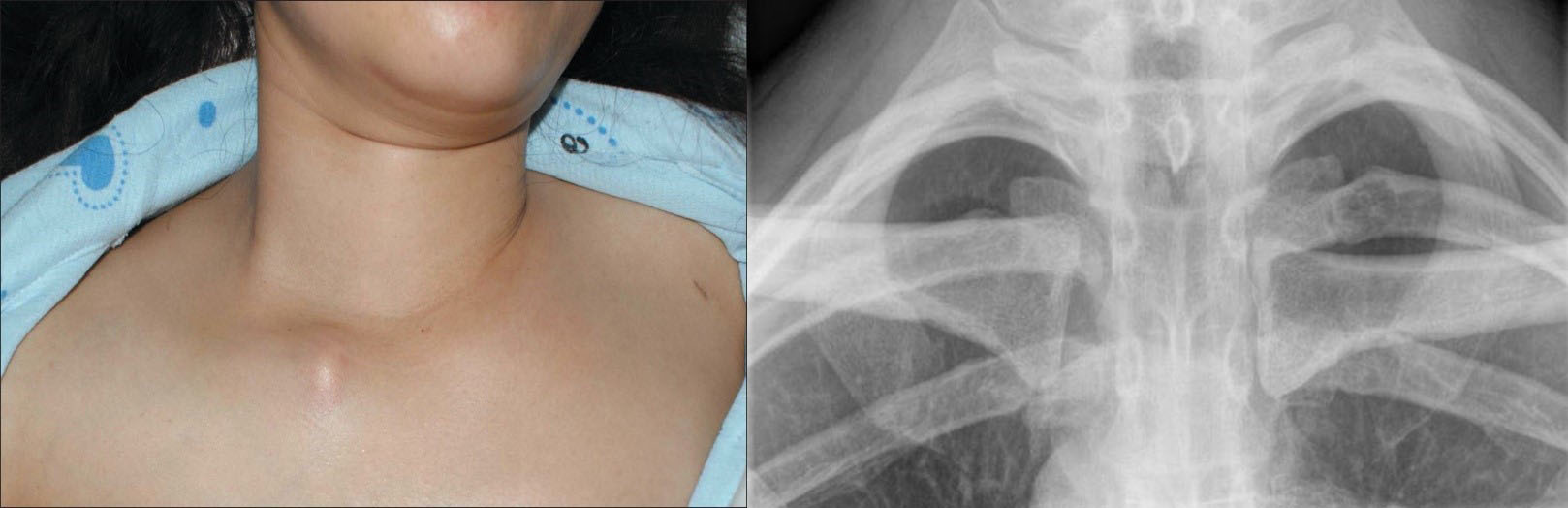 Sternoclavicular Joint Dislocation Serious Concern Or Not A Big Deal