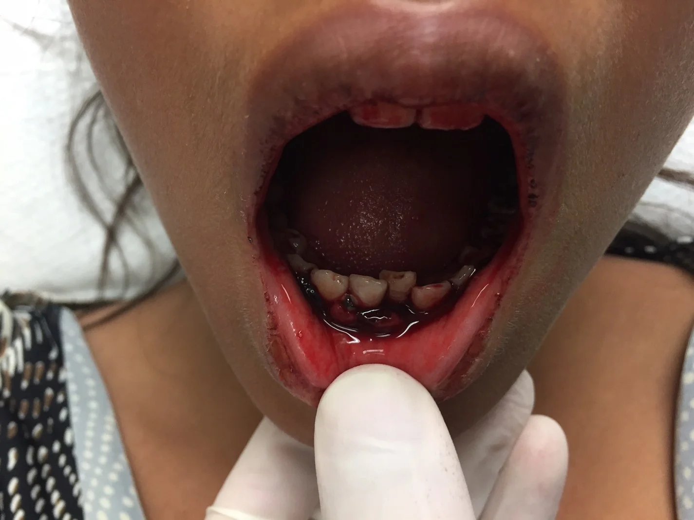 Image 1: Diffuse, oozing venous hemorrhage of the gingival mucosa