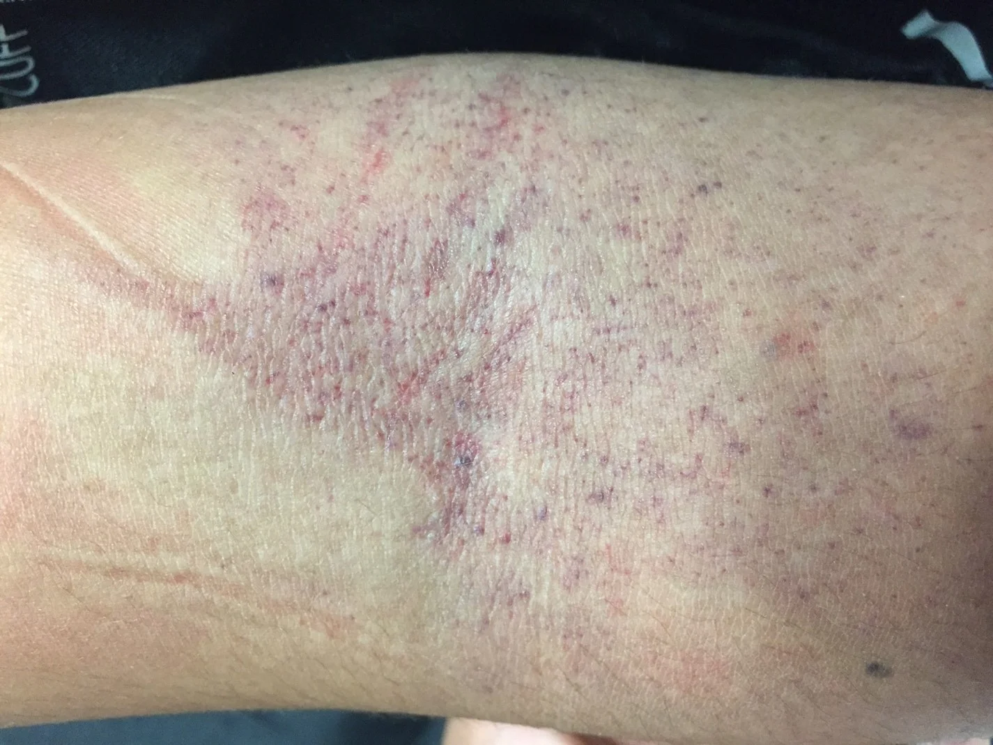 Image 3: a close-up view of the patient’s antecubital fossa. There are clearly greater than 10 petichiae within a square inch on this patient’s arm, thus making a “positive” tourniquet test.