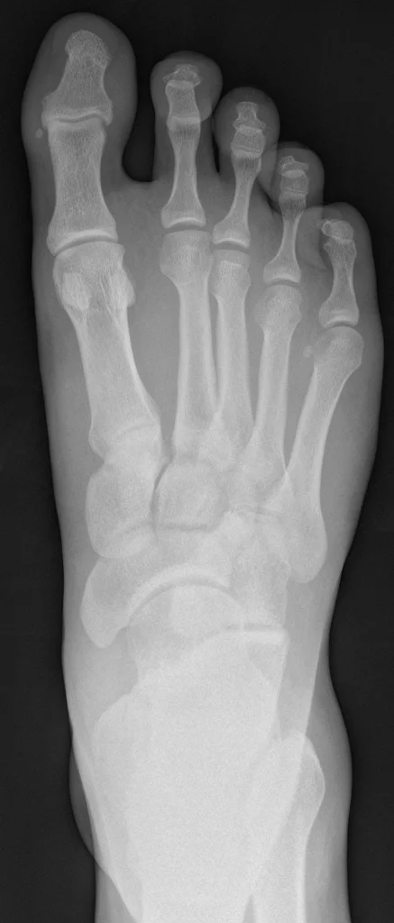 Image 3: Radiograph demonstrating widening between the first and second metatarsals (Click to expand)