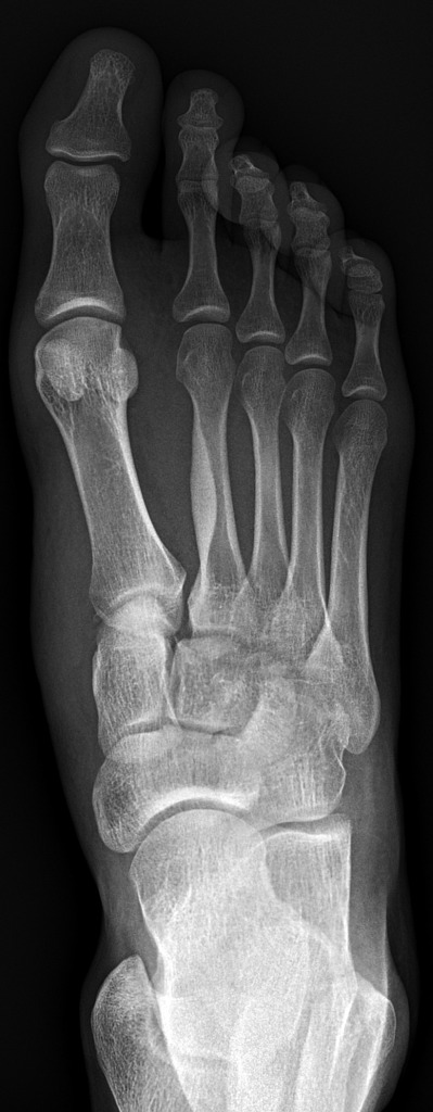 Image 4: Radiograph demonstrating malalignment of the medial and lateral borders of the third metatarsal and lateral cuneiform (Click to expand)