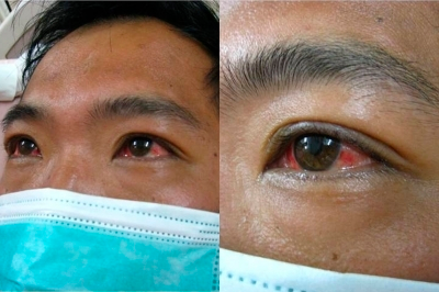 Figure 1: Conjunctival suffusion. Source: American Journal of Tropical Medicine and Hygiene, 2012.