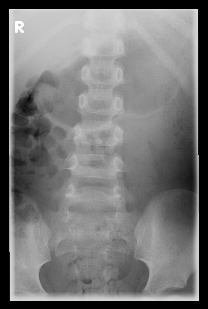 AP Lumbar XR.png