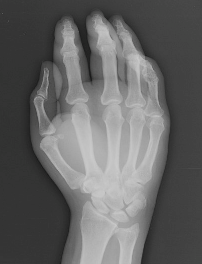 Figure 2. Plain radiograph of the hand.