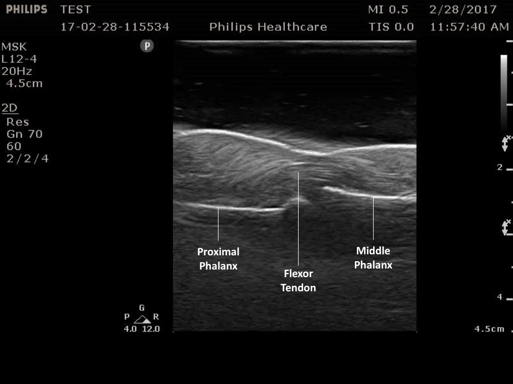 Figure 5. Normal flexor tendon anatomy on ultrasound.