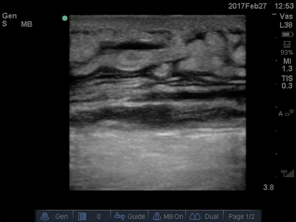 Figure 6. Cellulitis. Note the cobblestone appearance caused by subcutaneous edema.