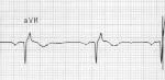 EKG Na Blocker.jpg