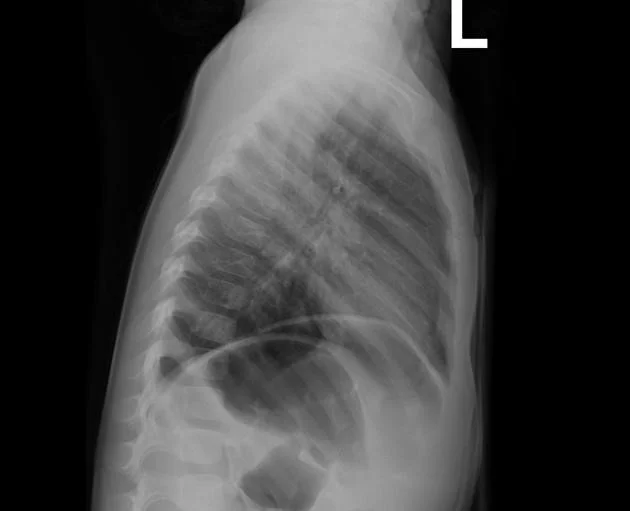 https://images.radiopaedia.org/images/627329/afc5beac8649e5e1fed60df4863281_big_gallery.jpg