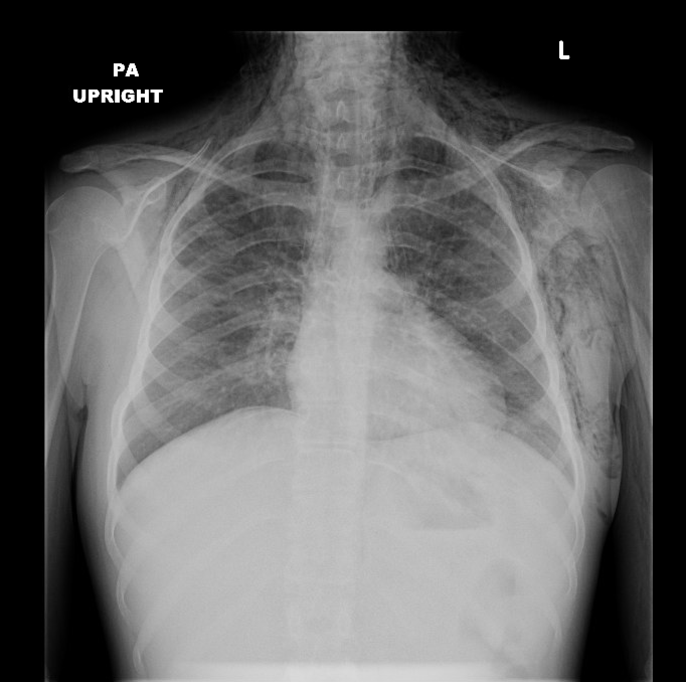 Rich Case 12 CXR AP.png