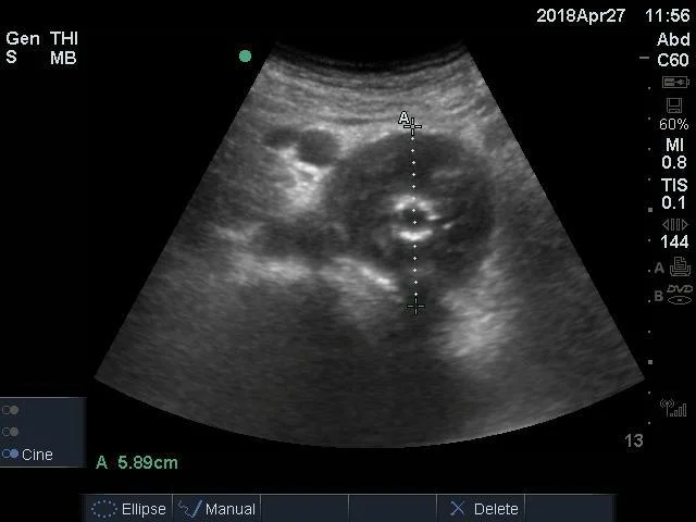 Figure 1: Proximal axial abdominal aortic ultrasound
