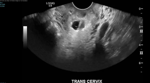 Cervical Ectopic Gif.gif