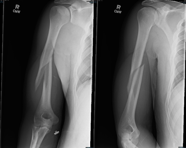 Thrower s Fracture Of The Humerus A Case Report BROWN EMERGENCY Thrower s Fracture Of The Humerus A Case Report BROWN EMERGENCY
