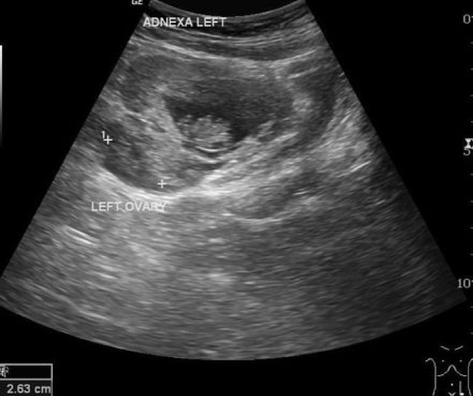 Figure 1: Ectopic pregnancy within the left adnexae. Source: Radiopaedia.org