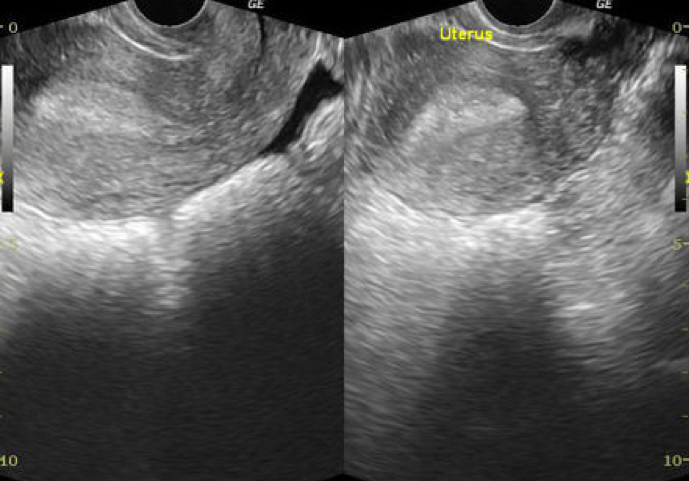 Figure 2: Fluid appreciated in the cul-de-sac posterior to the uterus. Source: Radiopaedia.org