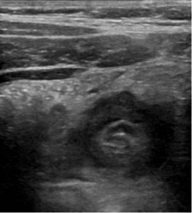 Figure 1. “Crescent in a donut” sign. Transverse view of intestinal intussusception. The hyperechoic crescent is formed by mesentery that has been dragged into the intussusception.