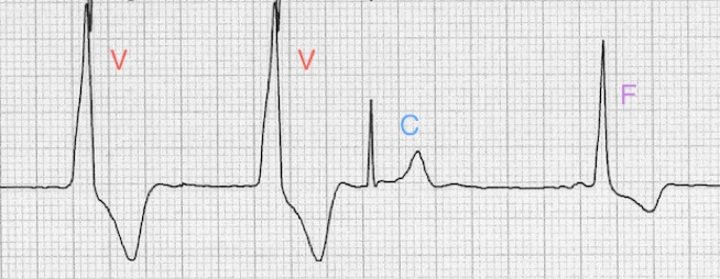 Figure 3: Fusion and capture beats after successful reperfusion.