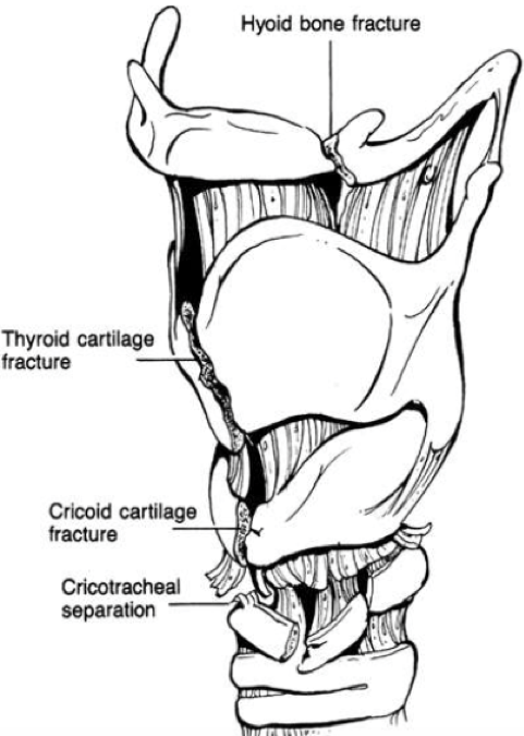 Figure 3: Types of laryngotracheal injuries. http://www.utmb.edu/otoref/grnds/laryng-trauma-070328/laryng trauma-070328.pdf