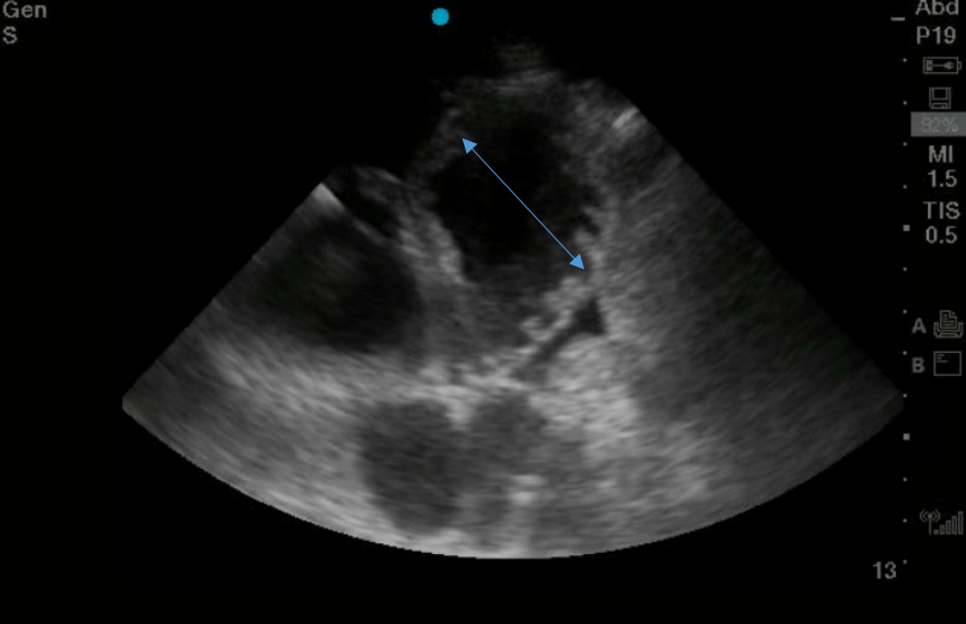 Dilated Bowel Loops >2.5cm