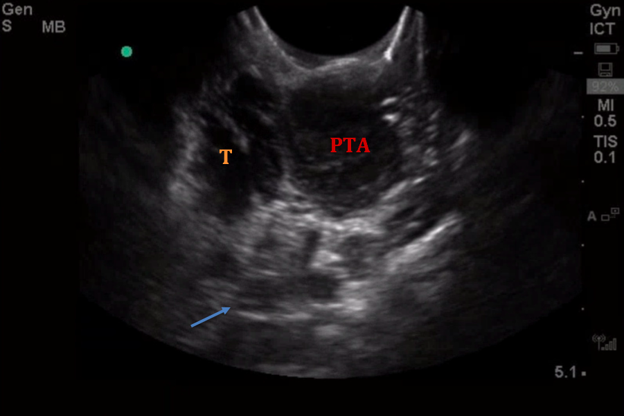 T - Tonsil, PTA - Abscess, Arrow - Carotid