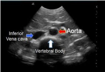Vertebral body: horseshoe shaped with hyperechoic anterior & posterior shadowing